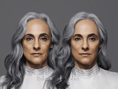 dermal-filler-before-after