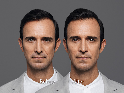 dermal-filler-beforeafter