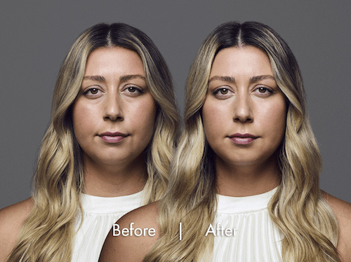 dermal-filler-before-after