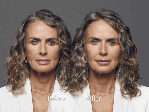 dermal-filler-before-after