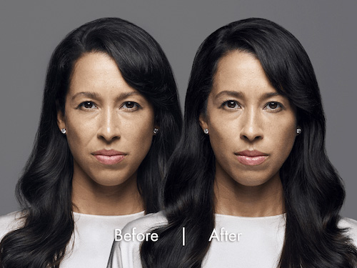 dermal-filler-before-after