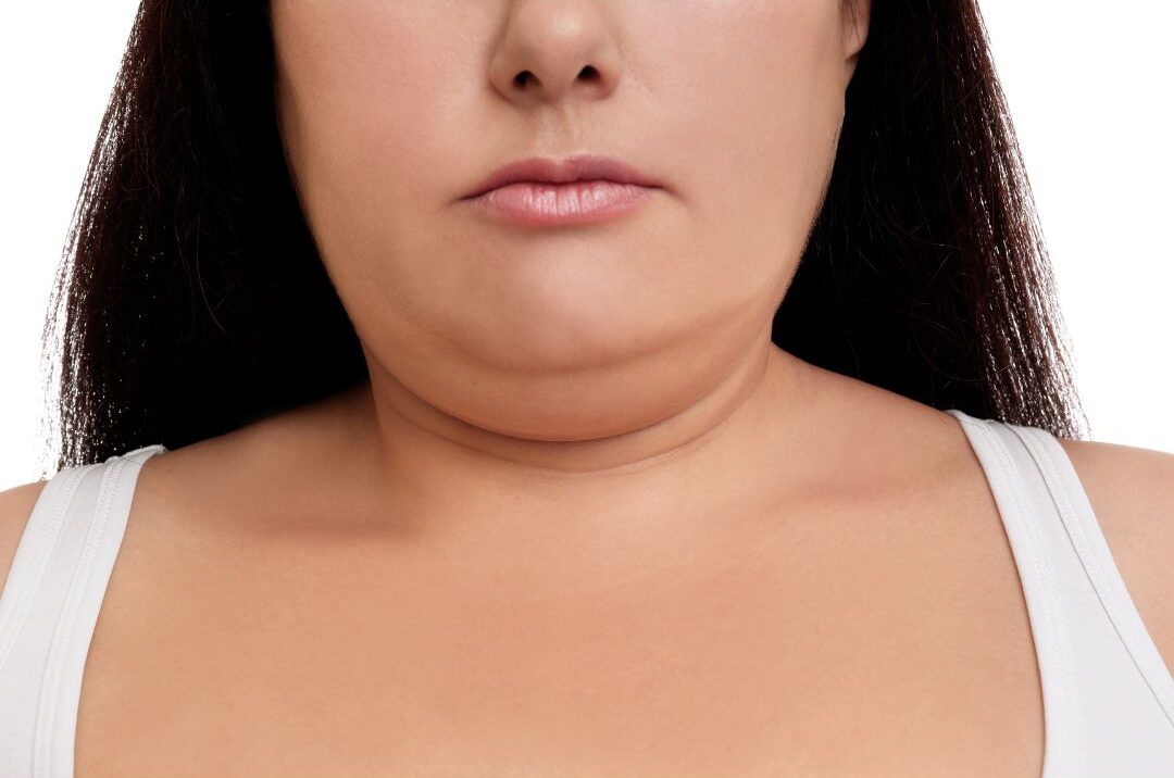 Double Chin