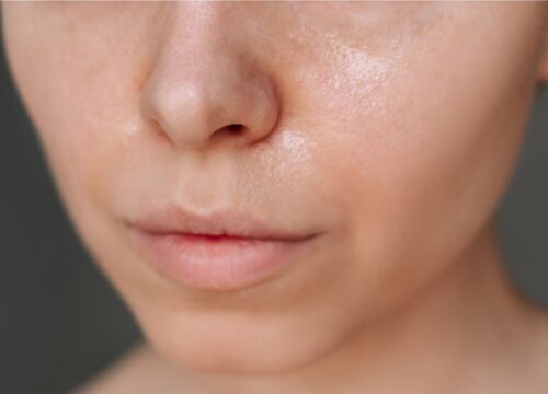 Dull Skin