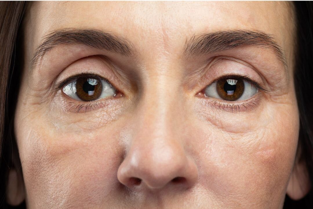 Facial Volume Loss