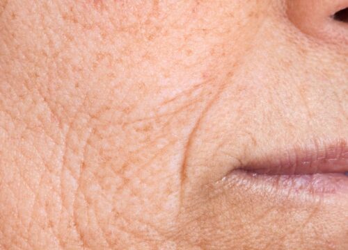 Fine Lines and Wrinkles