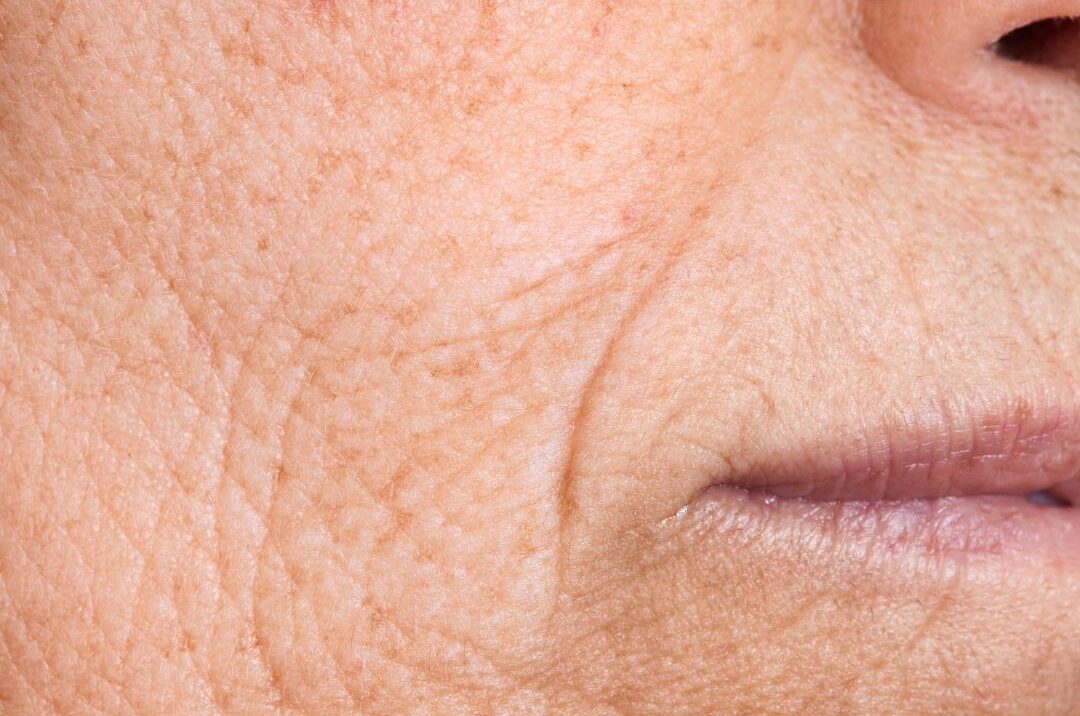 Fine Lines and Wrinkles