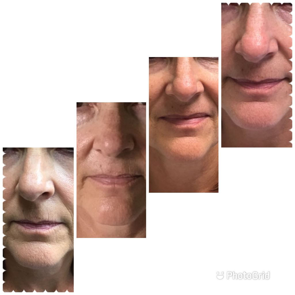Before and after peels results