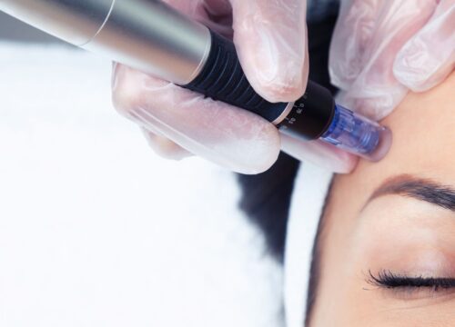 Microneedling: Collagen Stimulation and Skin Rejuvenation