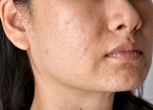 Uneven Skin Tone and Texture