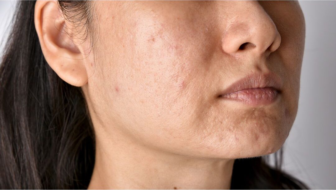 Uneven Skin Tone and Texture