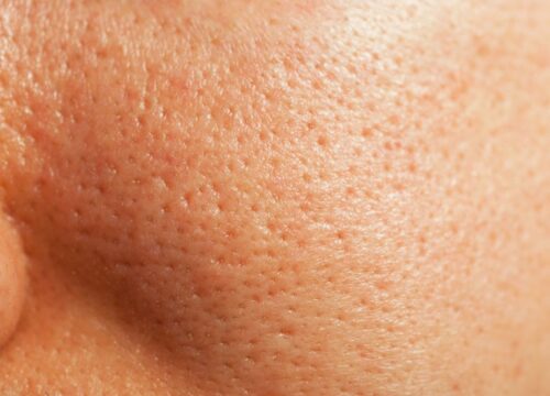 Enlarged Pores