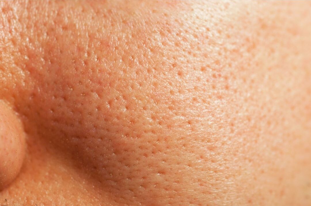 Enlarged Pores